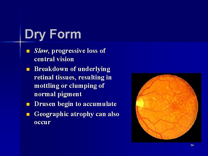 Dry Form n n Slow, progressive loss of central vision Breakdown of underlying retinal