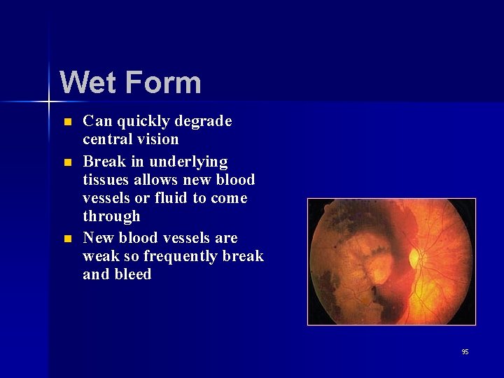 Wet Form n n n Can quickly degrade central vision Break in underlying tissues