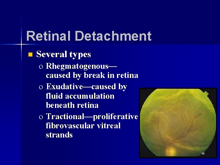 Retinal Detachment n Several types o Rhegmatogenous— caused by break in retina o Exudative—caused