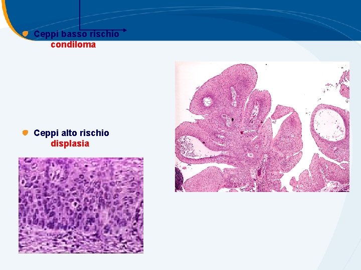 Ceppi basso rischio condiloma Ceppi alto rischio displasia Ceppi basso rischio condiloma Ceppi alto rischio displasia