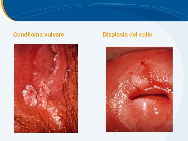 Condiloma vulvare Displasia del collo Condiloma vulvare Displasia del collo