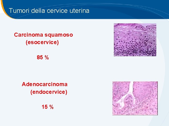 Tumori della cervice uterina Carcinoma squamoso (esocervice) 85 % Adenocarcinoma (endocervice) 15 % Tumori della cervice uterina Carcinoma squamoso (esocervice) 85 % Adenocarcinoma (endocervice) 15 %