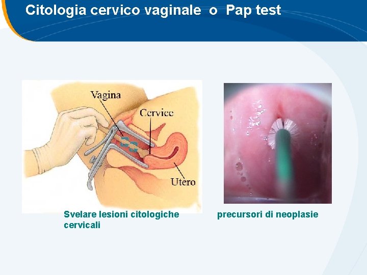 Citologia cervico vaginale o Pap test Svelare lesioni citologiche cervicali precursori di neoplasie Citologia cervico vaginale o Pap test Svelare lesioni citologiche cervicali precursori di neoplasie