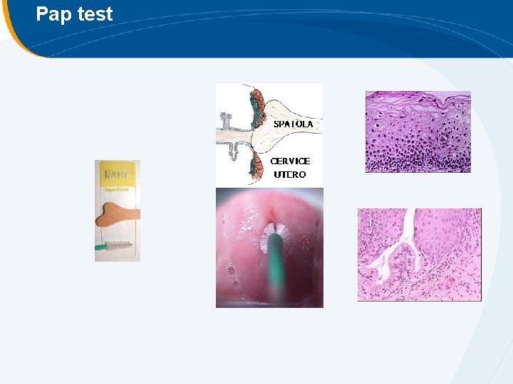 Pap test Pap test
