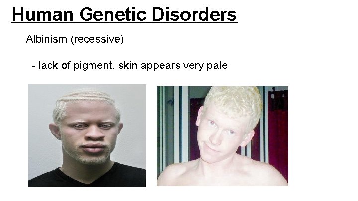 Human Genetic Disorders Albinism (recessive) - lack of pigment, skin appears very pale Human Genetic Disorders Albinism (recessive) - lack of pigment, skin appears very pale