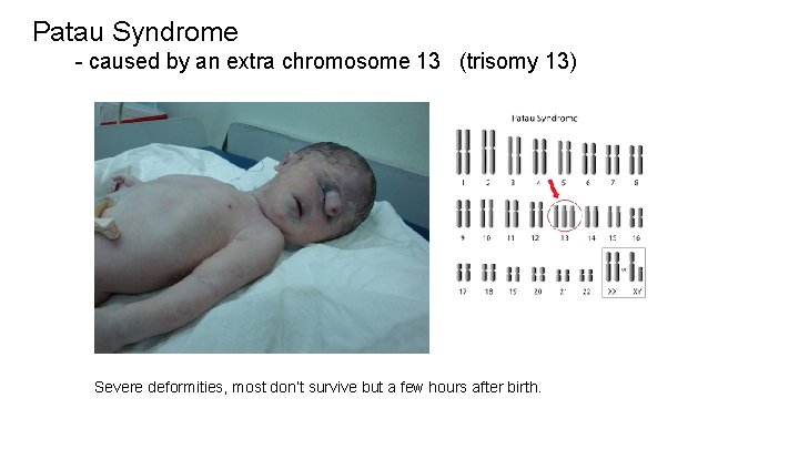 Patau Syndrome - caused by an extra chromosome 13 (trisomy 13) Severe deformities, most Patau Syndrome - caused by an extra chromosome 13 (trisomy 13) Severe deformities, most