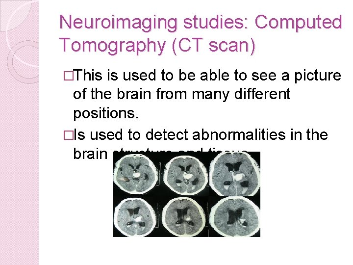 Neuroimaging studies: Computed Tomography (CT scan) �This is used to be able to see