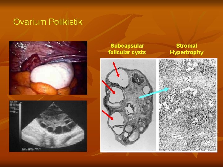 Ovarium Polikistik Subcapsular folicular cysts Stromal Hypertrophy 