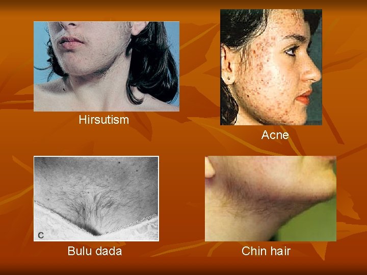 Hirsutism Acne Bulu dada Chin hair 