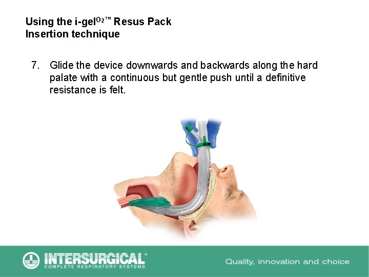 Using the i-gel. O 2™ Resus Pack Insertion technique 7. Glide the device downwards