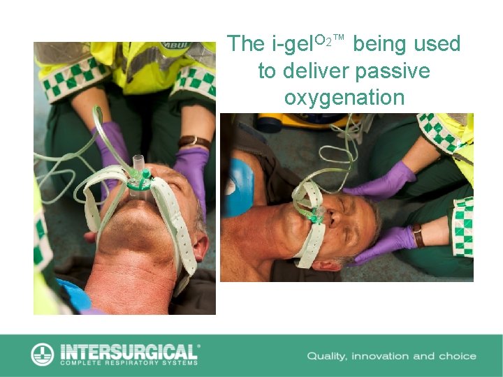 The i-gel. O 2™ being used to deliver passive oxygenation 