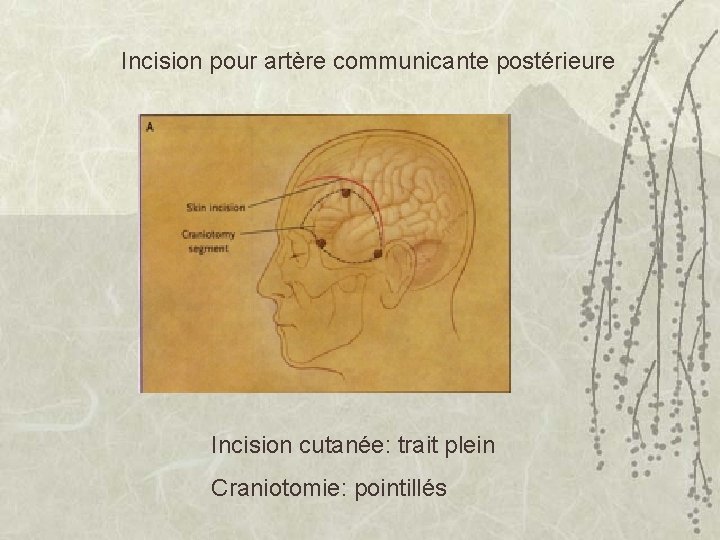 Incision pour artère communicante postérieure Incision cutanée: trait plein Craniotomie: pointillés 