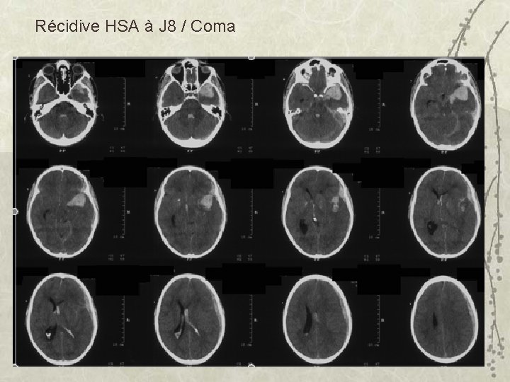 Récidive HSA à J 8 / Coma 
