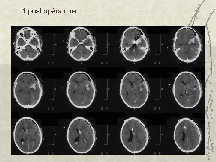 J 1 post opératoire 