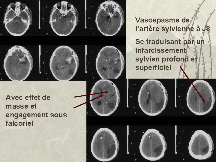 Vasospasme de l’artère sylvienne à J 8 Se traduisant par un infarcissement sylvien profond