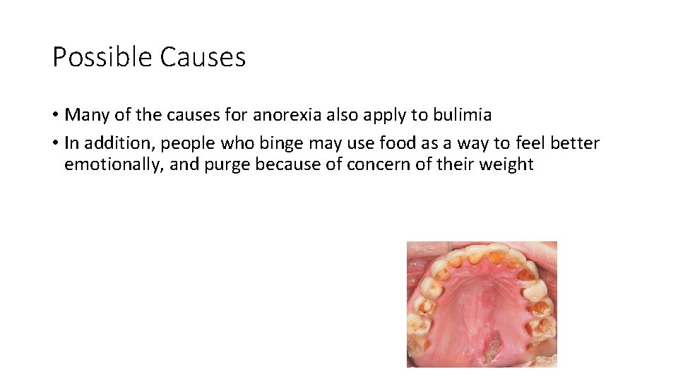 Possible Causes • Many of the causes for anorexia also apply to bulimia •