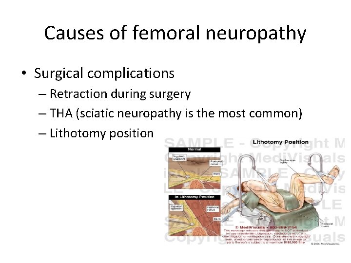 Causes of femoral neuropathy • Surgical complications – Retraction during surgery – THA (sciatic Causes of femoral neuropathy • Surgical complications – Retraction during surgery – THA (sciatic