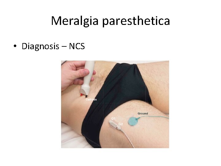 Meralgia paresthetica • Diagnosis – NCS Meralgia paresthetica • Diagnosis – NCS