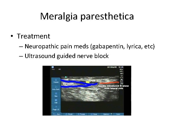 Meralgia paresthetica • Treatment – Neuropathic pain meds (gabapentin, lyrica, etc) – Ultrasound guided Meralgia paresthetica • Treatment – Neuropathic pain meds (gabapentin, lyrica, etc) – Ultrasound guided