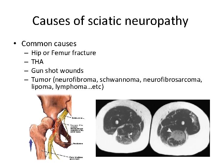 Causes of sciatic neuropathy • Common causes – – Hip or Femur fracture THA Causes of sciatic neuropathy • Common causes – – Hip or Femur fracture THA