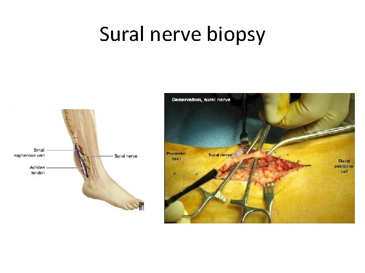 Sural nerve biopsy Sural nerve biopsy