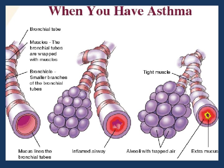 Atopy and Allergic diseases Prof Mohamed Osman Gad