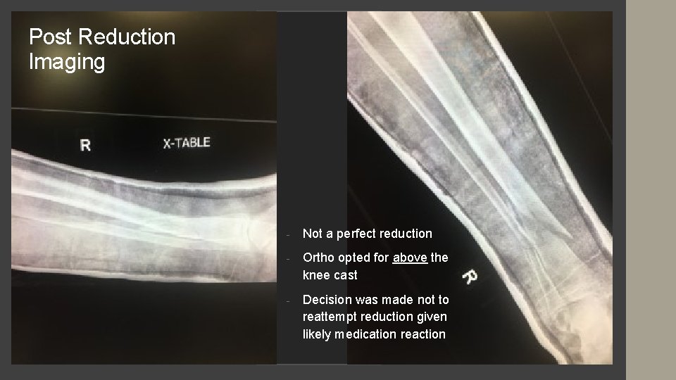 Post Reduction Imaging - Not a perfect reduction - Ortho opted for above the