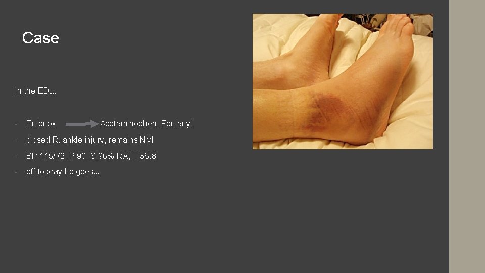 Case In the ED…. - Entonox Acetaminophen, Fentanyl - closed R. ankle injury, remains