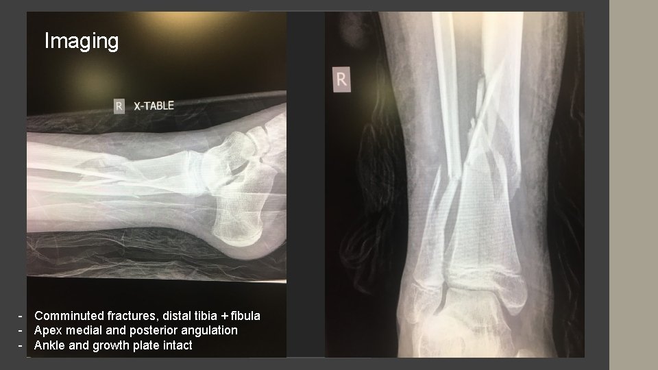 Imaging - Comminuted fractures, distal tibia + fibula - Apex medial and posterior angulation