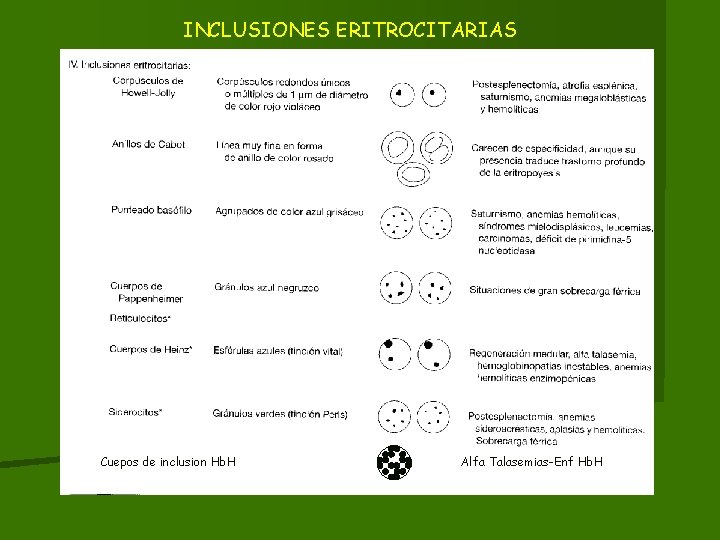 INCLUSIONES ERITROCITARIAS Cuepos de inclusion Hb. H Alfa Talasemias-Enf Hb. H 