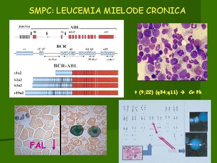 SMPC: LEUCEMIA MIELODE CRONICA t (9; 22) (q 34; q 11) Cr Ph FAL SMPC: LEUCEMIA MIELODE CRONICA t (9; 22) (q 34; q 11) Cr Ph FAL