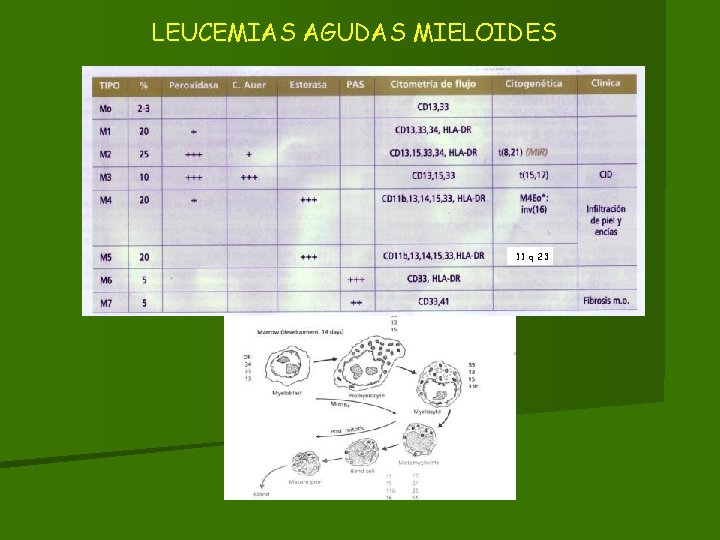 LEUCEMIAS AGUDAS MIELOIDES 11 q 23 