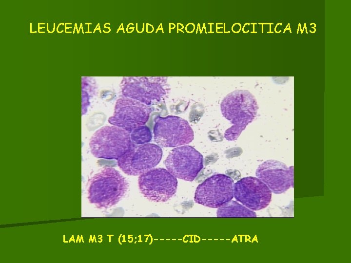 LEUCEMIAS AGUDA PROMIELOCITICA M 3 LAM M 3 T (15; 17)-----CID-----ATRA 