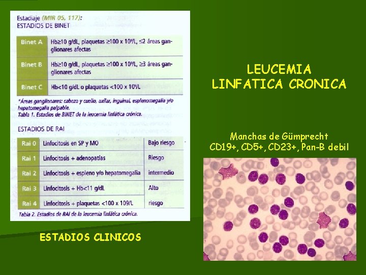 LEUCEMIA LINFATICA CRONICA Manchas de Gümprecht CD 19+, CD 5+, CD 23+, Pan-B debil