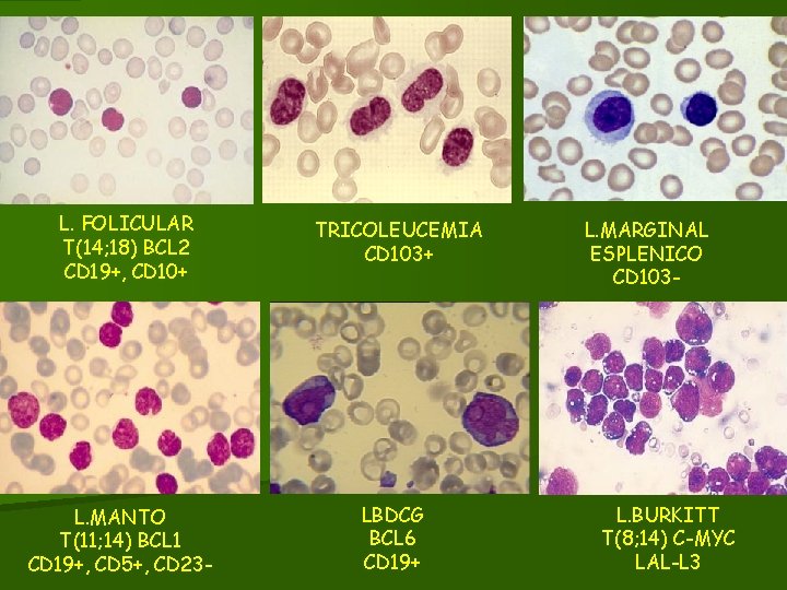 L. FOLICULAR T(14; 18) BCL 2 CD 19+, CD 10+ L. MANTO T(11; 14)