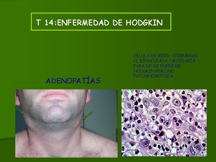 T 14: ENFERMEDAD DE HODGKIN ADENOPATÍAS CÉLULA DE REED- STERNBERG: CL BINUCLEADA. NECESARIA PARA