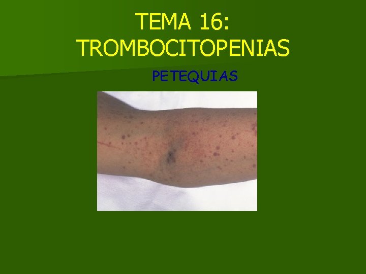 TEMA 16: TROMBOCITOPENIAS PETEQUIAS 