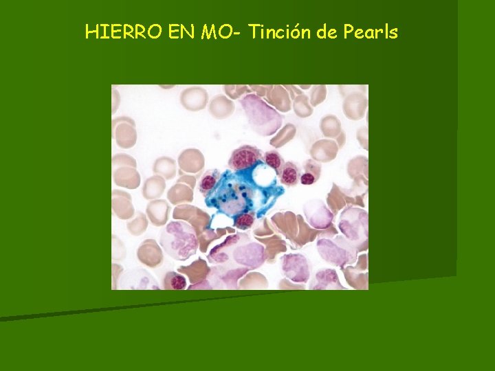 HIERRO EN MO- Tinción de Pearls 