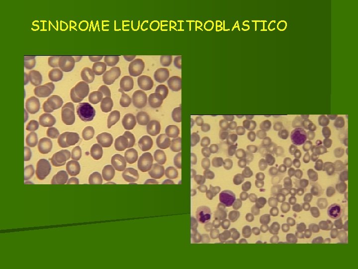 SINDROME LEUCOERITROBLASTICO 