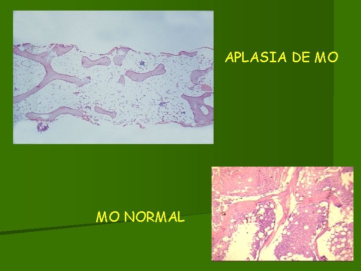 APLASIA DE MO MO NORMAL 