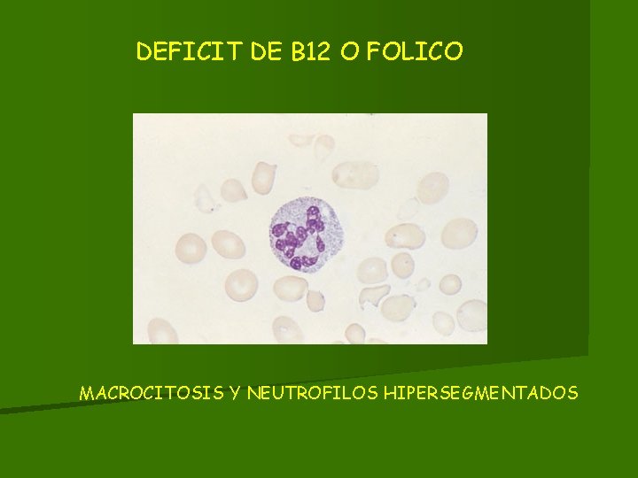 DEFICIT DE B 12 O FOLICO MACROCITOSIS Y NEUTROFILOS HIPERSEGMENTADOS 