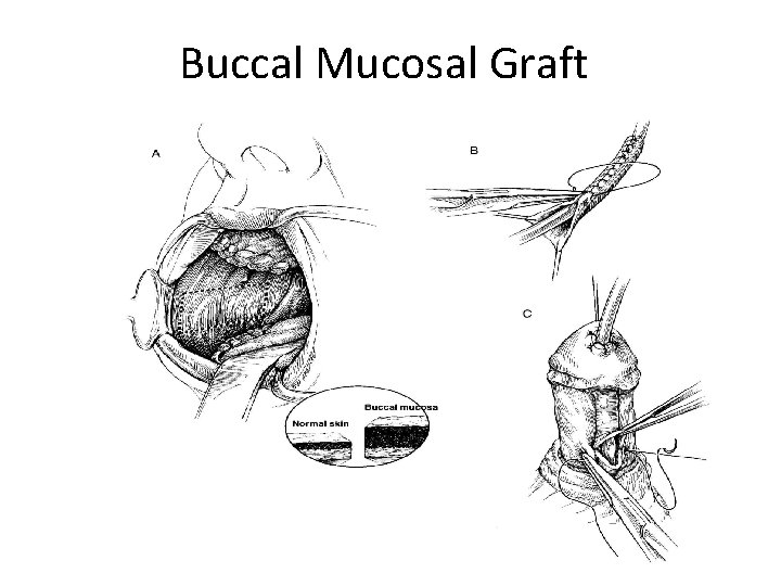 Buccal Mucosal Graft 