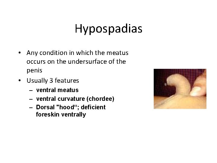 Hypospadias • Any condition in which the meatus occurs on the undersurface of the