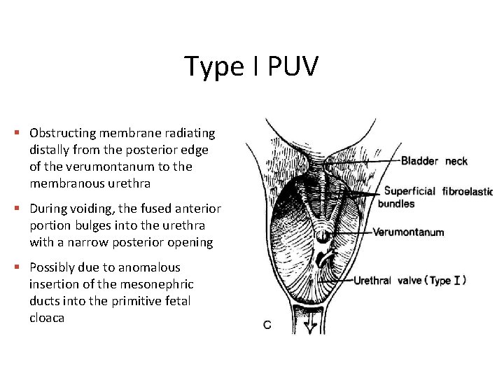 Type I PUV § Obstructing membrane radiating distally from the posterior edge of the