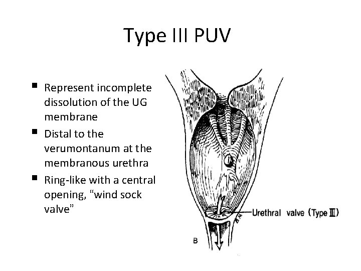 Type III PUV § § § Represent incomplete dissolution of the UG membrane Distal