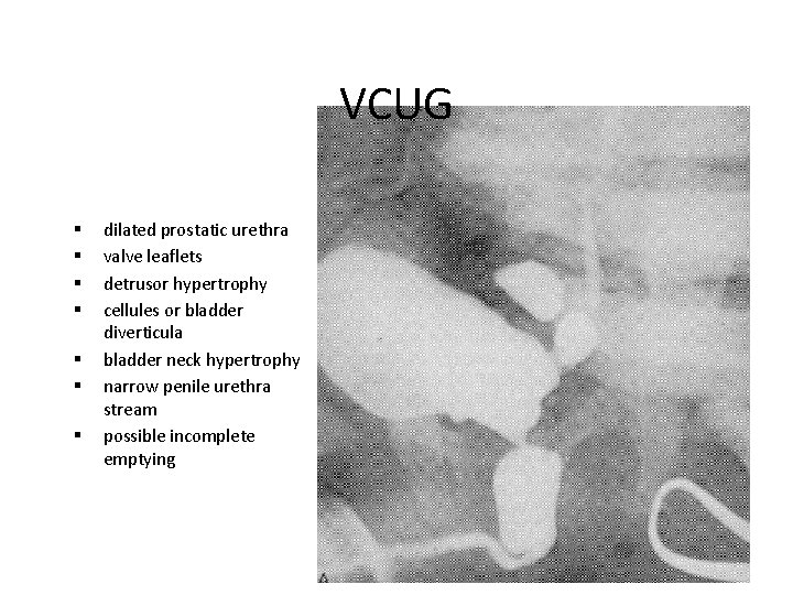 VCUG § § § § dilated prostatic urethra valve leaflets detrusor hypertrophy cellules or