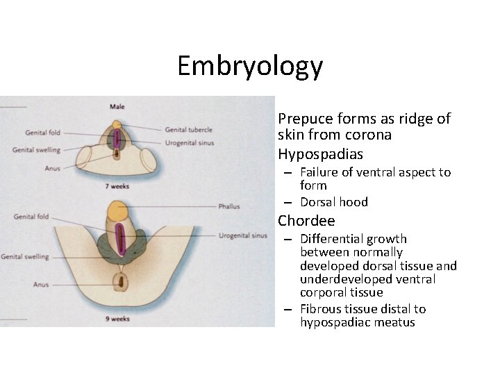 Embryology • Prepuce forms as ridge of skin from corona • Hypospadias – Failure