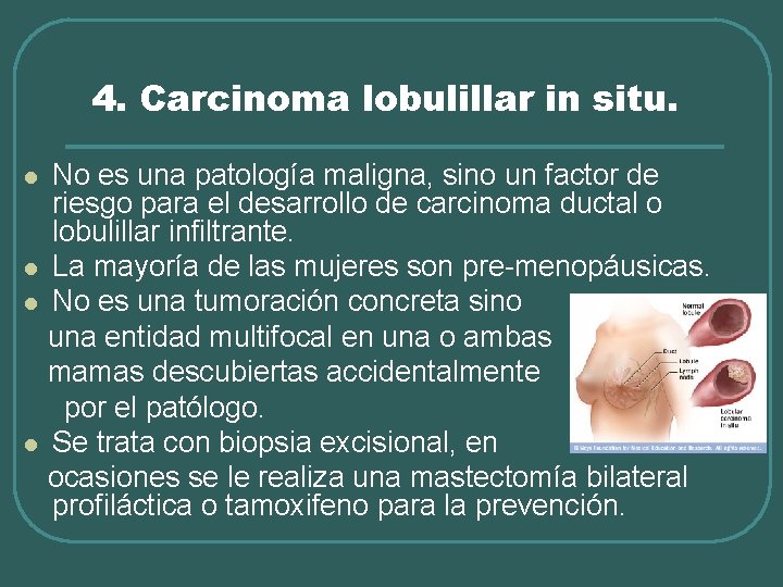 4. Carcinoma lobulillar in situ. No es una patología maligna, sino un factor de
