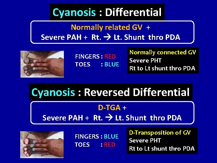 Cyanosis : Differential Normally related GV + Severe PAH + Rt. Lt. Shunt thro