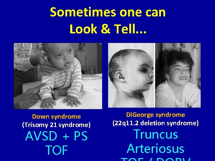 Sometimes one can Look & Tell. . . Down syndrome (Trisomy 21 syndrome) AVSD